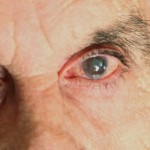 Pink eye treatment tips