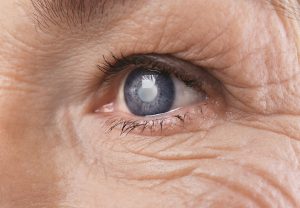 Recovering from Cataract Surgery in Long Island