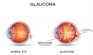 Glaucoma Treatment in Long Island, NY